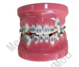 Fixed Orthodontic Model (Dislocation)