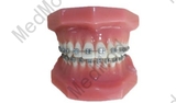 Fixed Orthodontic Model (Normal)
