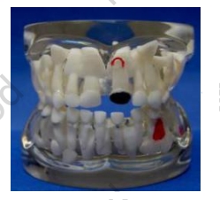 Transparent Milk Teeth Pathology Model