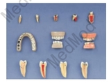 Dental Diseases Model -