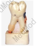 Dissected Model of Dental Disease
