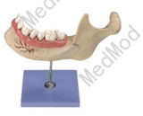 Lower Jaw of 18-year-old