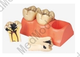 Dissected Model of Dental Caries