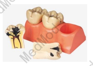 Dissected Model of Dental Caries