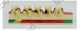 Periodontal Disease Model