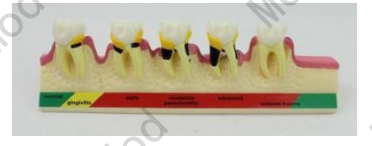 Periodontal Disease Model