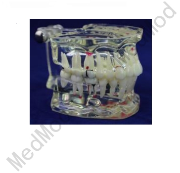 Transparent Dental Pathology Model