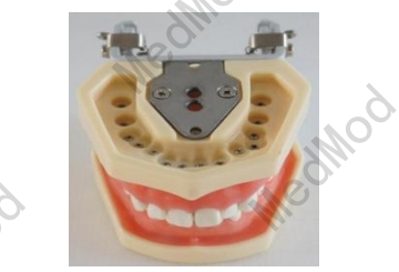 Standard Teeth Model with Nuts Fixation