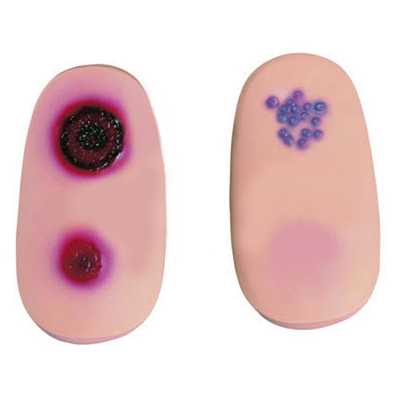 Variola Lesion Modules