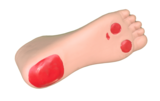 Disbetic Foot Nursing Model