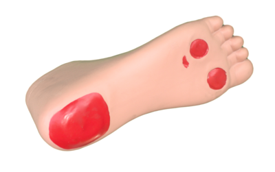 Disbetic Foot Nursing Model