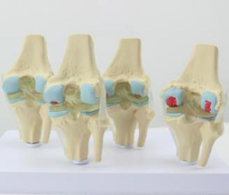 4 Stages Knee Joints Synthesis Model
