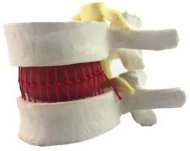 Lumbar Disc Herniation Demonstration Model