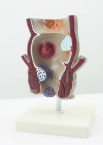 Pathological Model of the Rectum