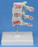 Osteoporosis Model