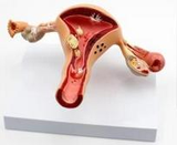 Uterus Pathological Model