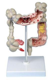 Diseased Large Intestines