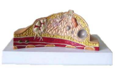 Diseased Breast Model