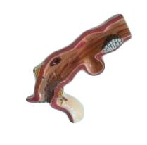 Esophagus Pathological Model