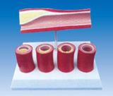 Thrombus Model