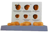 Prostate Pathological Model