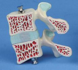 Osteoporosis Model