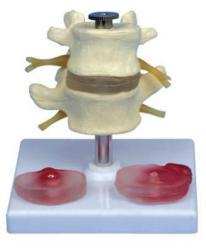 Inter-vertebra Disc with Pathologic Symptom, life size