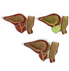 Prostate Pathological Model