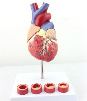 Heart with Thrombus Model