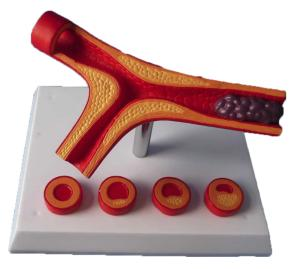 Pathological Vessel Model