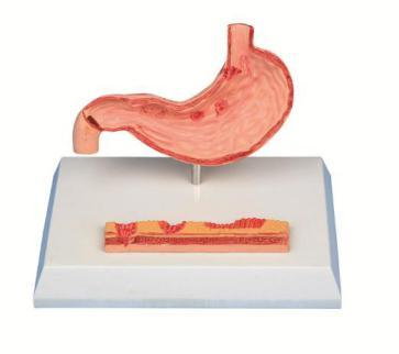 Disease Stomach