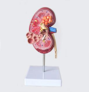 Diseased Kidney