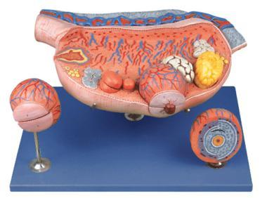 Enlarged Ovary