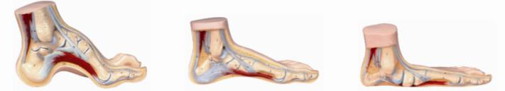 Normal, Flat, Arched Foot